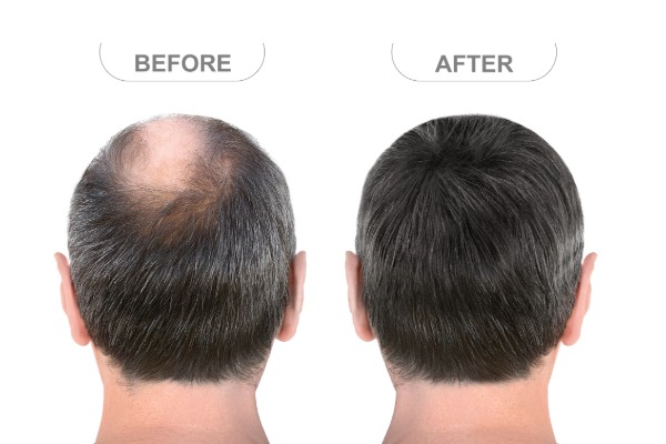 Hair Loss Regrowth